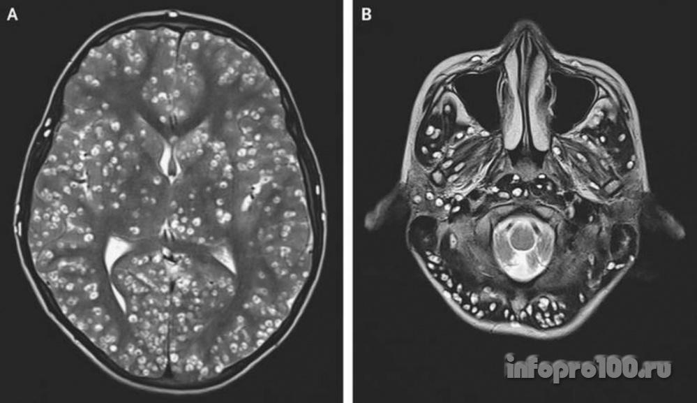 Снимок мозга индийца с личинками в мозгу