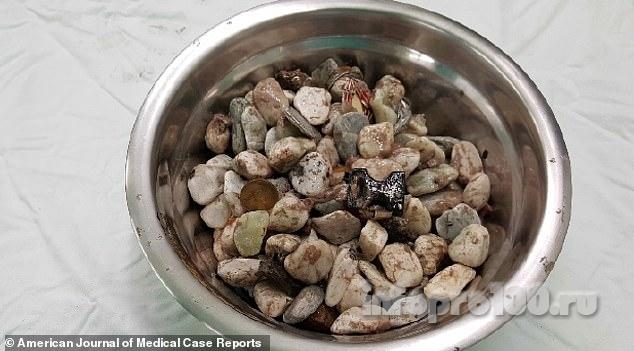 Камни, извлеченные из кишечника пациента